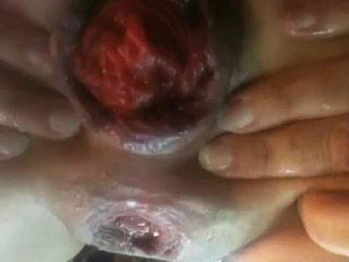 Incredible homemade very closeup huge prolapse anal penetrate
