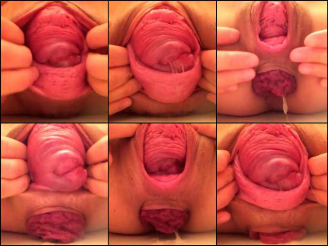 asshole prolapse girl webcam,webcam chick anus prolapse close up,depraved girl vaginal prolapse,colossal cervix very close asian chick