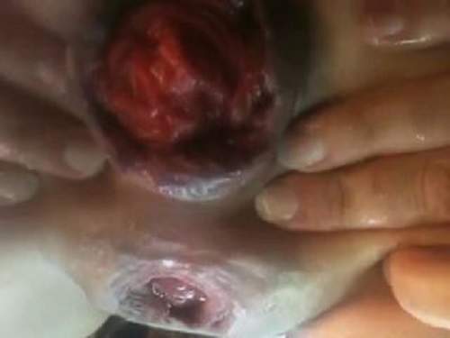 Sexy girl stretched her sweet colossal sized anus prolapse