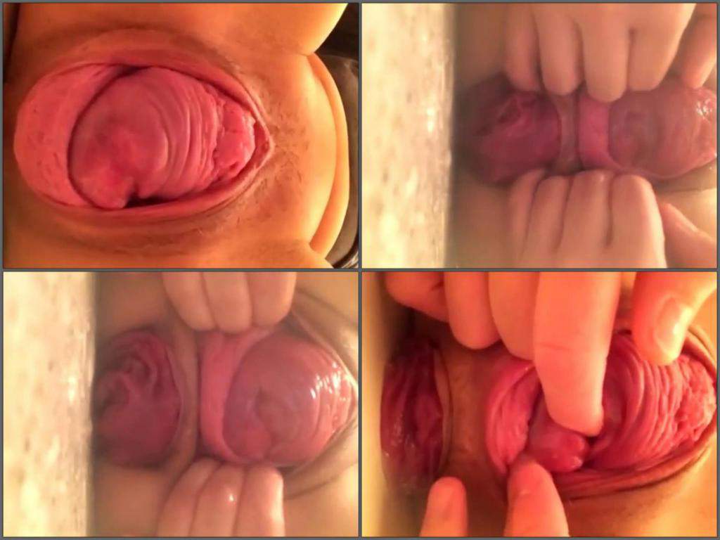 Cervix prolapse porn