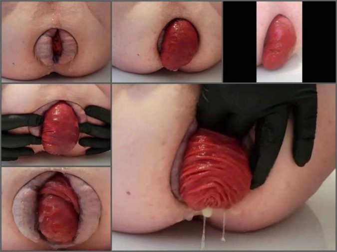 male anal,male prolapse,prolapse video,prolapse porn,huge anal prolapse,monster anal prolapse,amateur male anal,male anal 2018