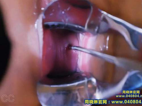 Chinese Zhou Xiaolin speculum and urethral sounding